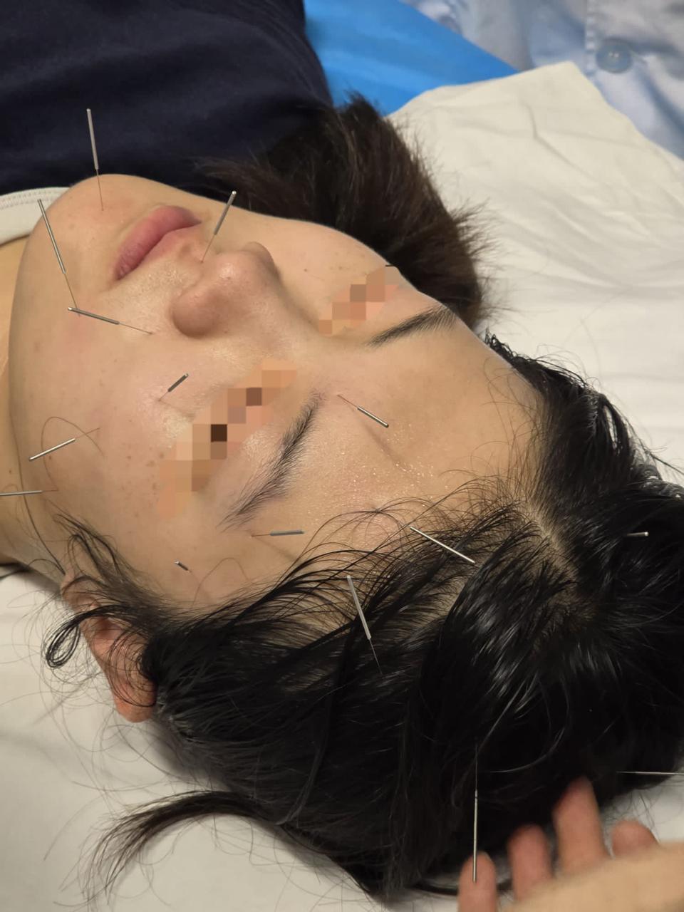 Facial acupuncture treatment with fine needles